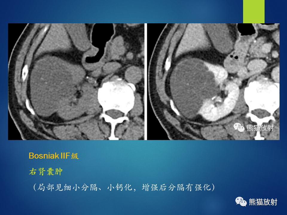影像PPT - 【病例】肾脏囊肿1例CT影像-51