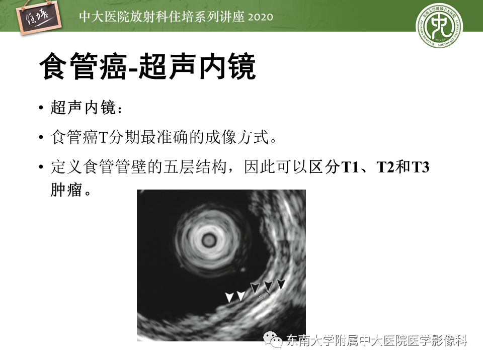 影像PPT - 【PPT】食管癌影像-临床分期-8