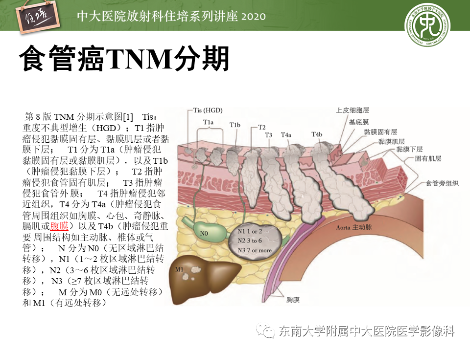 影像PPT - 【PPT】食管癌影像-临床分期-14
