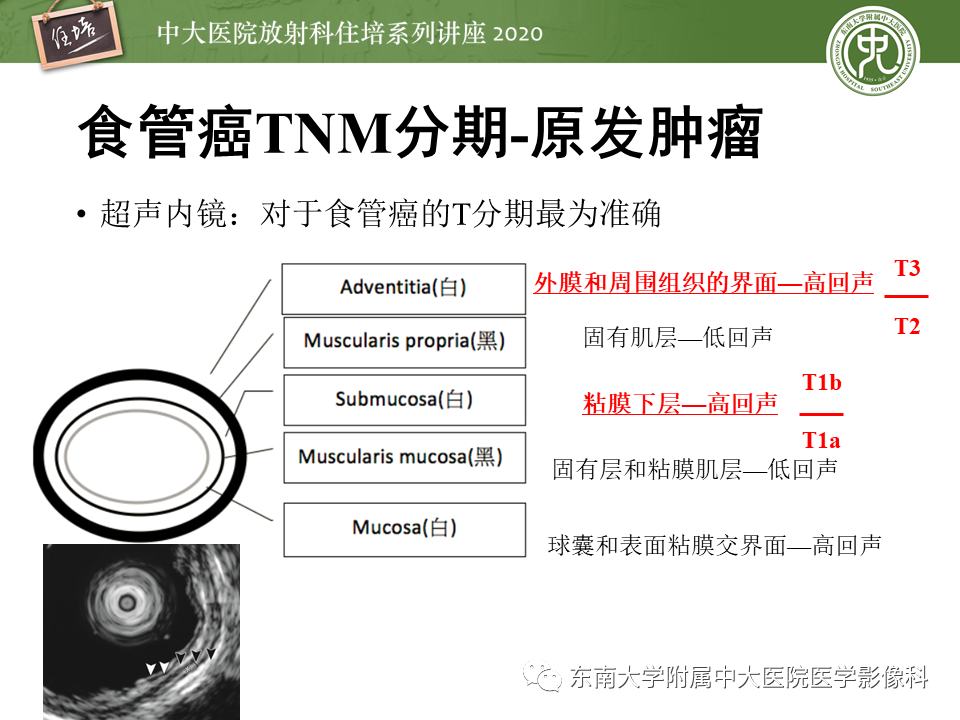 影像PPT - 【PPT】食管癌影像-临床分期-18