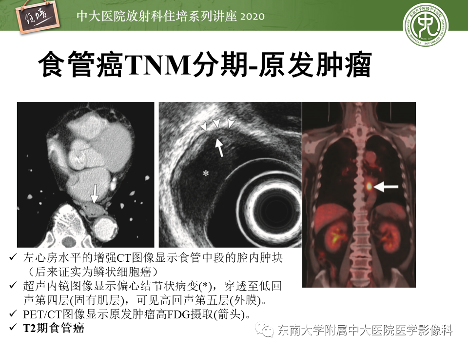 影像PPT - 【PPT】食管癌影像-临床分期-20