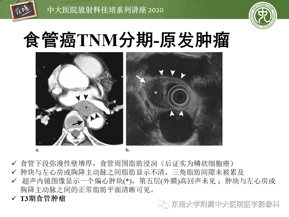 影像PPT - 【PPT】食管癌影像-临床分期-21