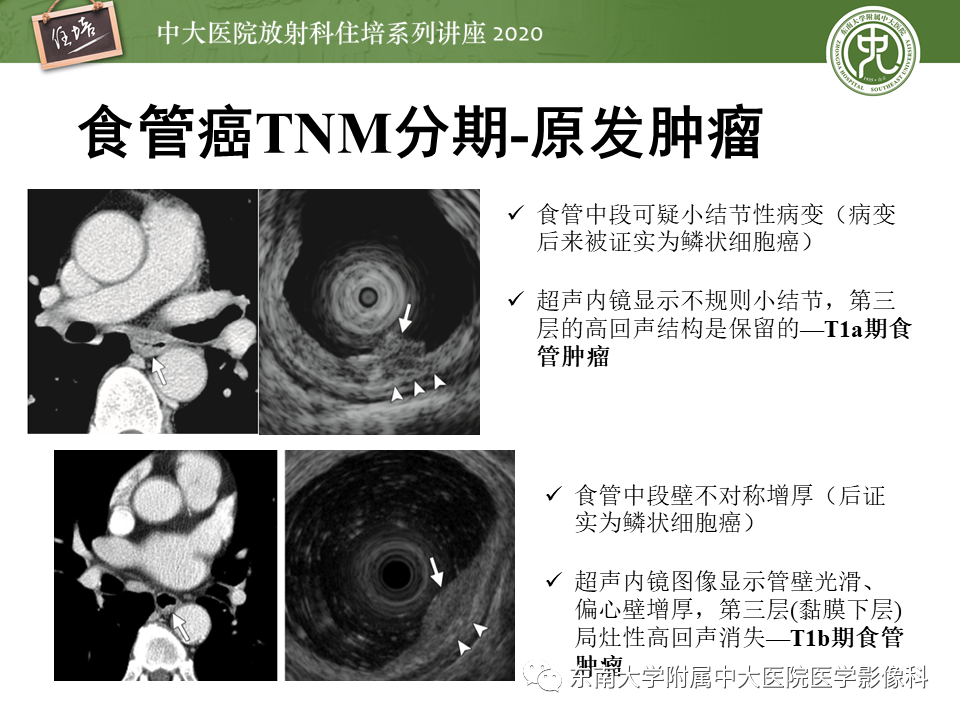 影像PPT - 【PPT】食管癌影像-临床分期-19