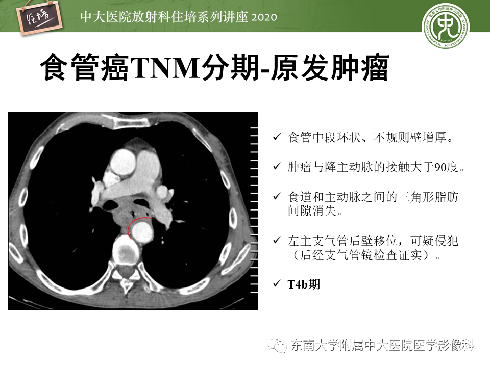 影像PPT - 【PPT】食管癌影像-临床分期-24