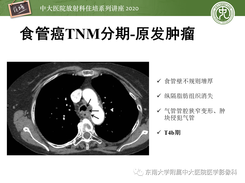 影像PPT - 【PPT】食管癌影像-临床分期-25