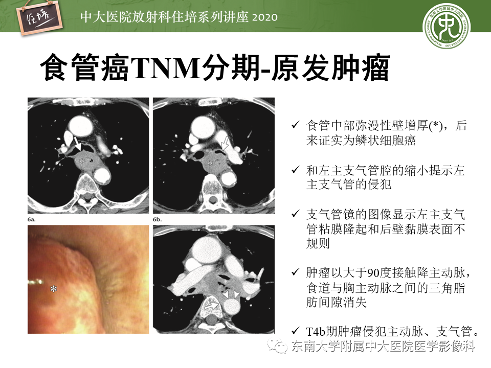 影像PPT - 【PPT】食管癌影像-临床分期-26