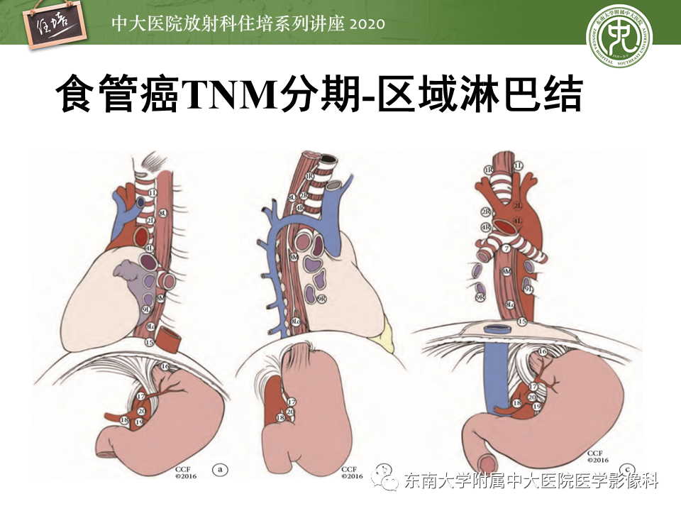 影像PPT - 【PPT】食管癌影像-临床分期-28