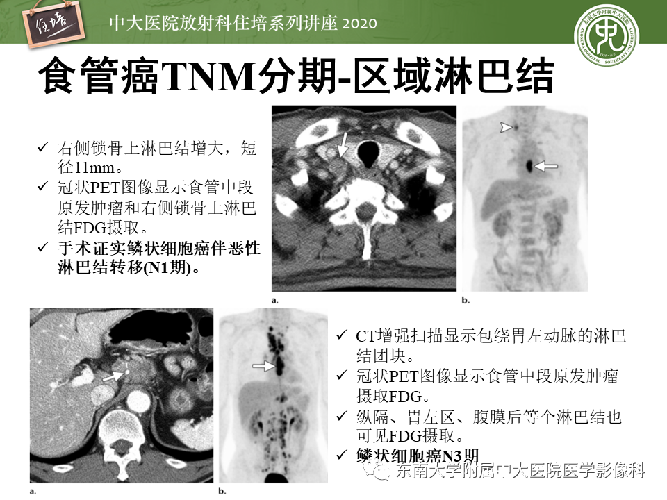 影像PPT - 【PPT】食管癌影像-临床分期-30