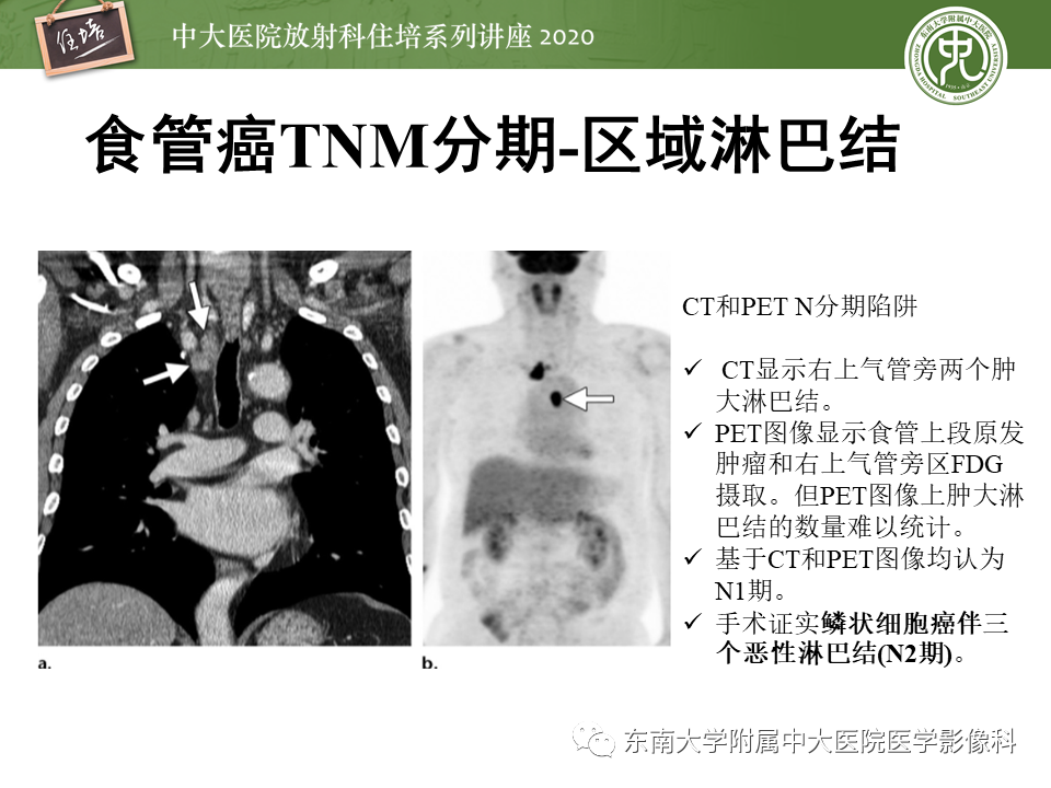 影像PPT - 【PPT】食管癌影像-临床分期-31