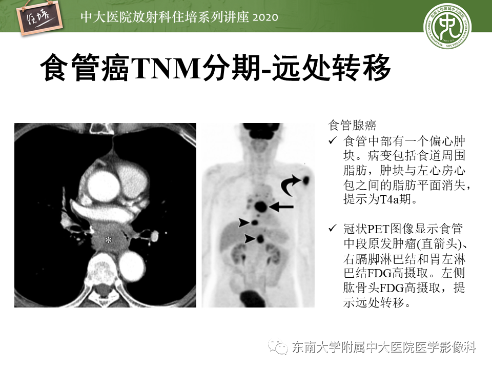 影像PPT - 【PPT】食管癌影像-临床分期-33