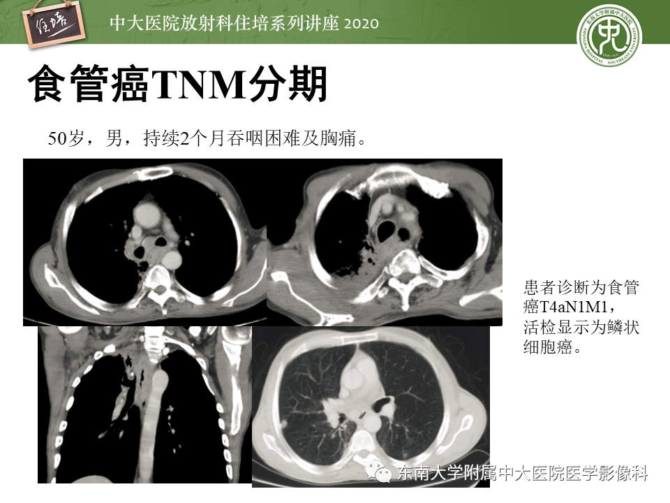 影像PPT - 【PPT】食管癌影像-临床分期-34