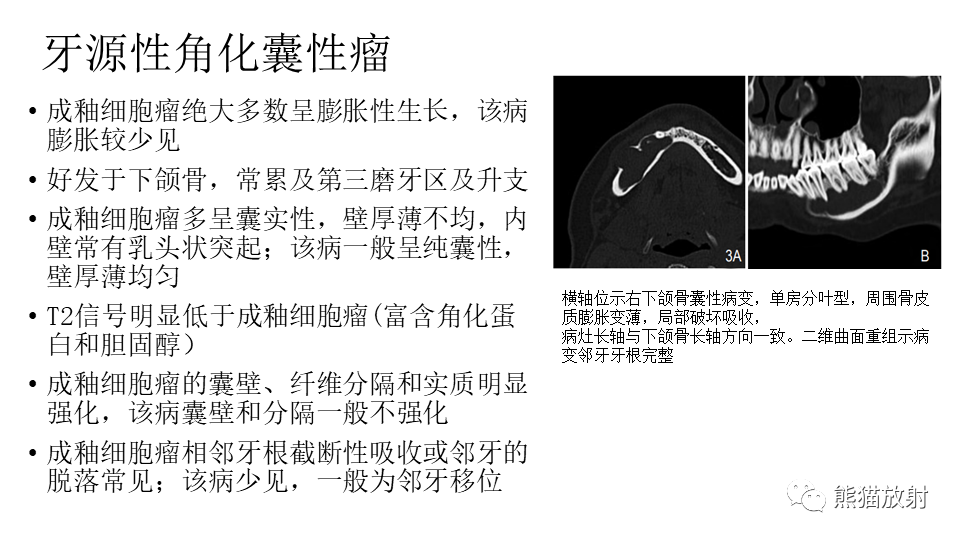影像PPT - 【病例】下颌骨成釉细胞瘤2例CT-26