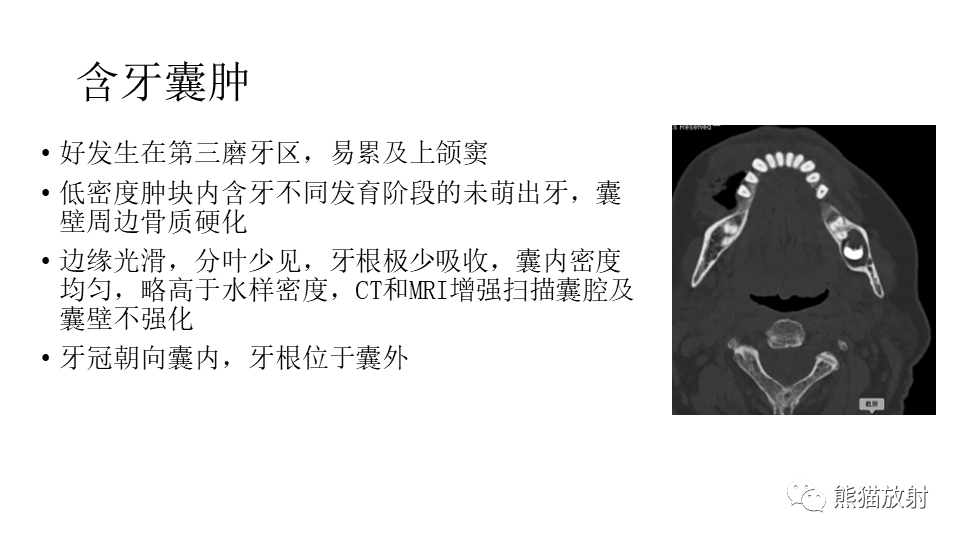 影像PPT - 【病例】下颌骨成釉细胞瘤2例CT-27