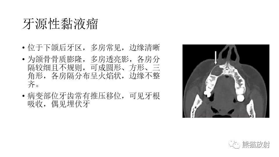影像PPT - 【病例】下颌骨成釉细胞瘤2例CT-28