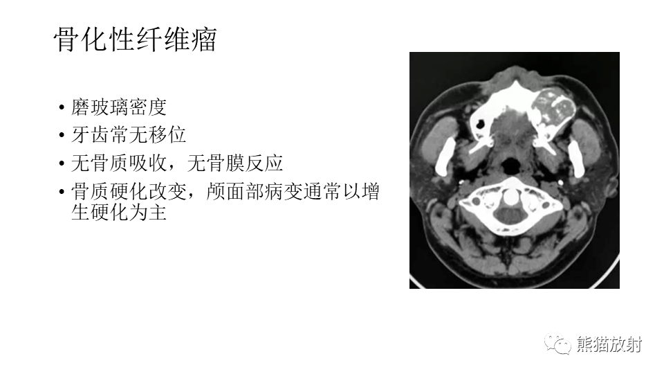 影像PPT - 【病例】下颌骨成釉细胞瘤2例CT-29