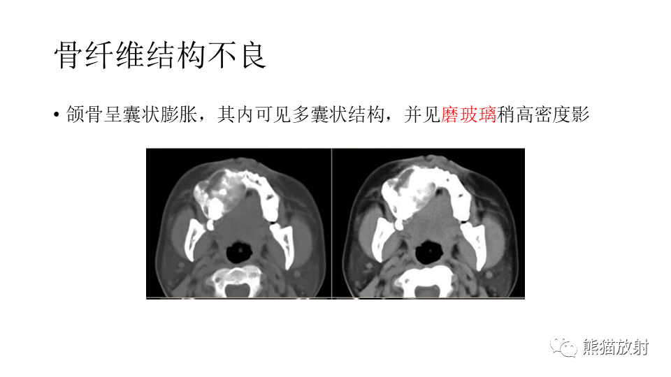 影像PPT - 【病例】下颌骨成釉细胞瘤2例CT-30