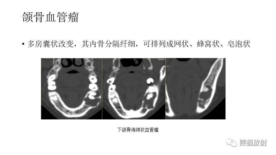 影像PPT - 【病例】下颌骨成釉细胞瘤2例CT-31