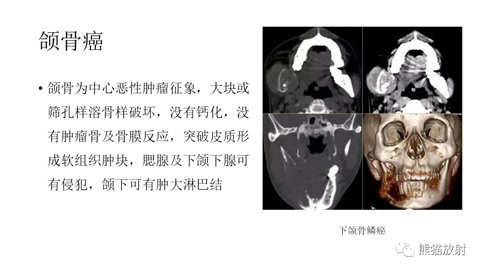 影像PPT - 【病例】下颌骨成釉细胞瘤2例CT-32