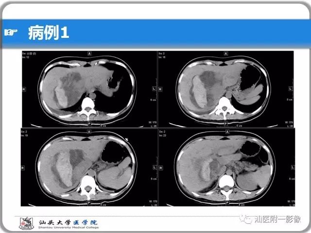 影像PPT - 【PPT】肝脏占位性病变再学习、分析与体会-3