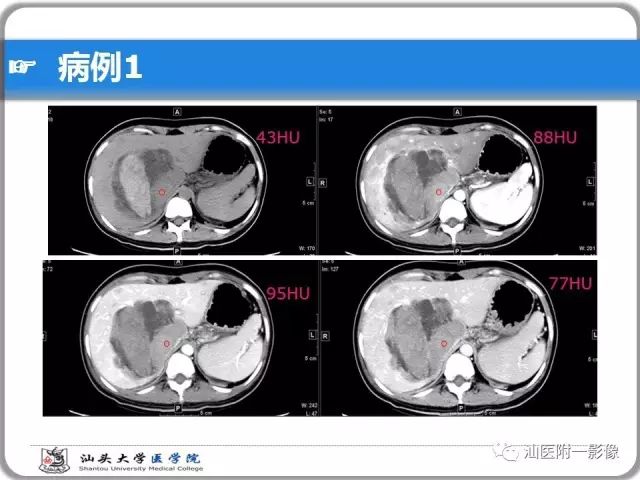 影像PPT - 【PPT】肝脏占位性病变再学习、分析与体会-4