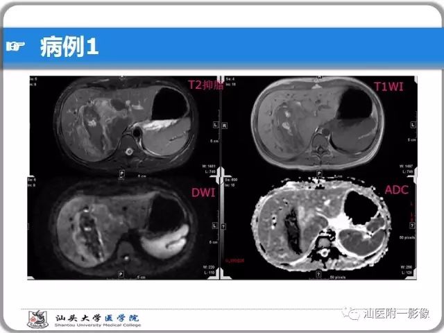 影像PPT - 【PPT】肝脏占位性病变再学习、分析与体会-6