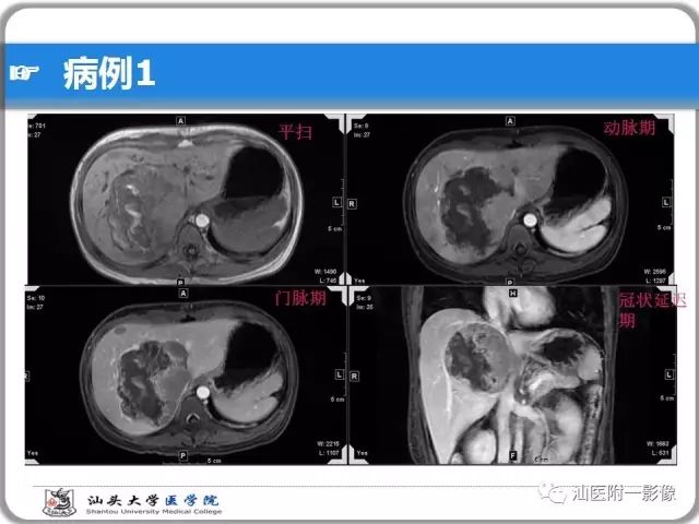 影像PPT - 【PPT】肝脏占位性病变再学习、分析与体会-7