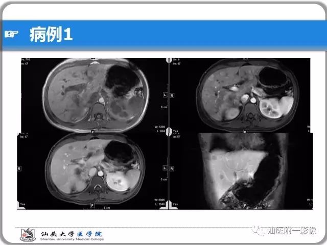 影像PPT - 【PPT】肝脏占位性病变再学习、分析与体会-8