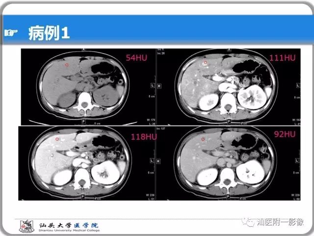 影像PPT - 【PPT】肝脏占位性病变再学习、分析与体会-5
