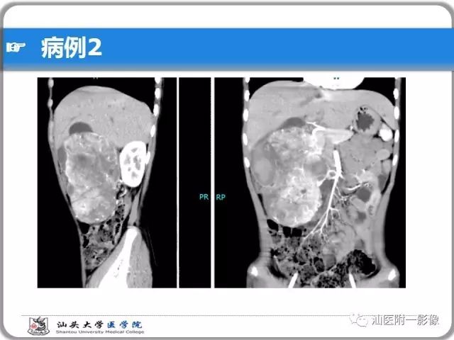 影像PPT - 【PPT】肝脏占位性病变再学习、分析与体会-14