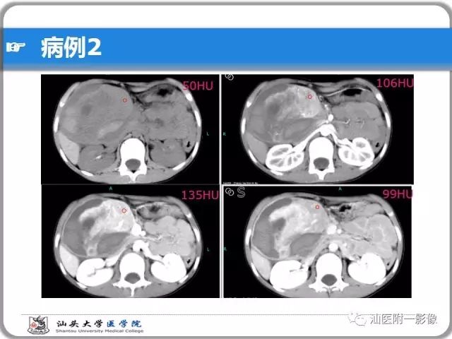 影像PPT - 【PPT】肝脏占位性病变再学习、分析与体会-13