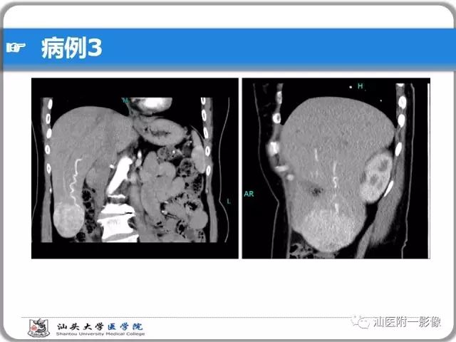 影像PPT - 【PPT】肝脏占位性病变再学习、分析与体会-22