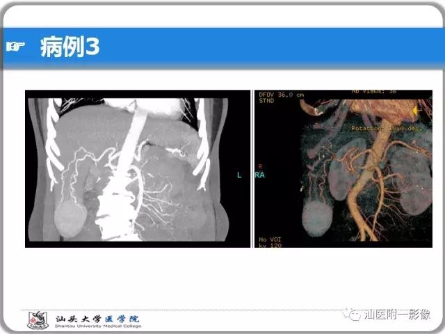 影像PPT - 【PPT】肝脏占位性病变再学习、分析与体会-23