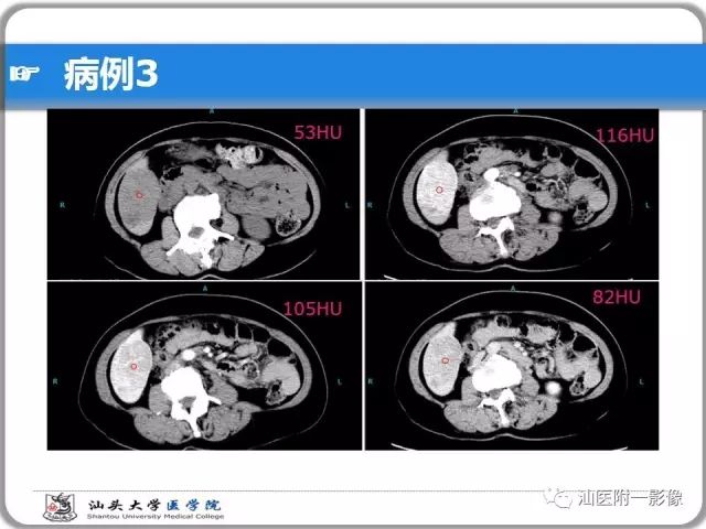 影像PPT - 【PPT】肝脏占位性病变再学习、分析与体会-21