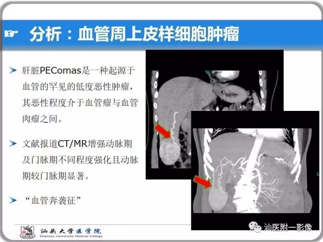 影像PPT - 【PPT】肝脏占位性病变再学习、分析与体会-27