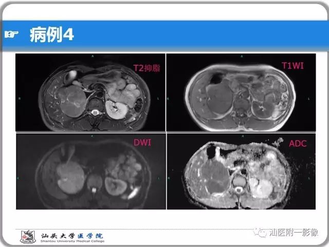 影像PPT - 【PPT】肝脏占位性病变再学习、分析与体会-29