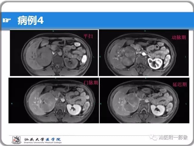 影像PPT - 【PPT】肝脏占位性病变再学习、分析与体会-30