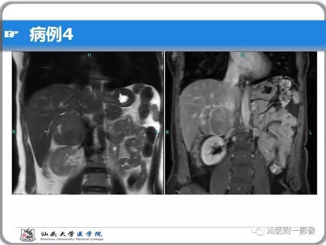 影像PPT - 【PPT】肝脏占位性病变再学习、分析与体会-31