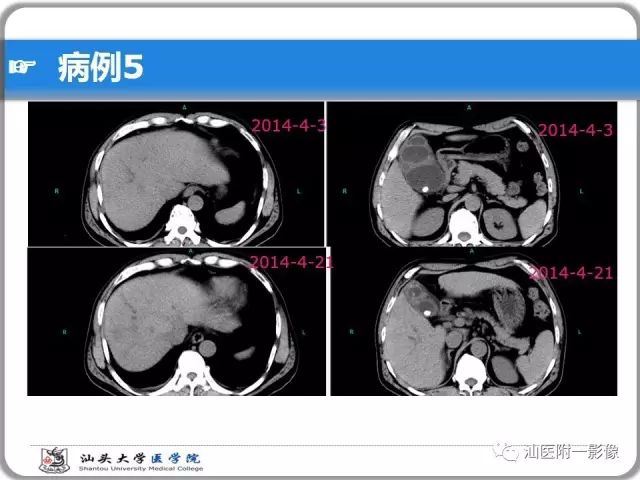 影像PPT - 【PPT】肝脏占位性病变再学习、分析与体会-35