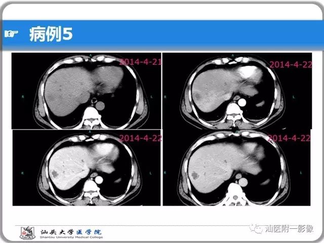 影像PPT - 【PPT】肝脏占位性病变再学习、分析与体会-36