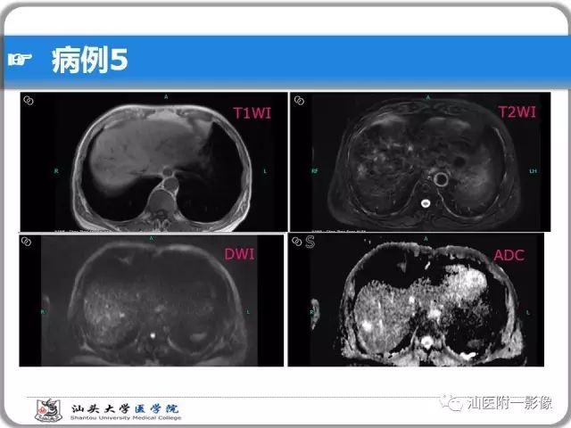 影像PPT - 【PPT】肝脏占位性病变再学习、分析与体会-37