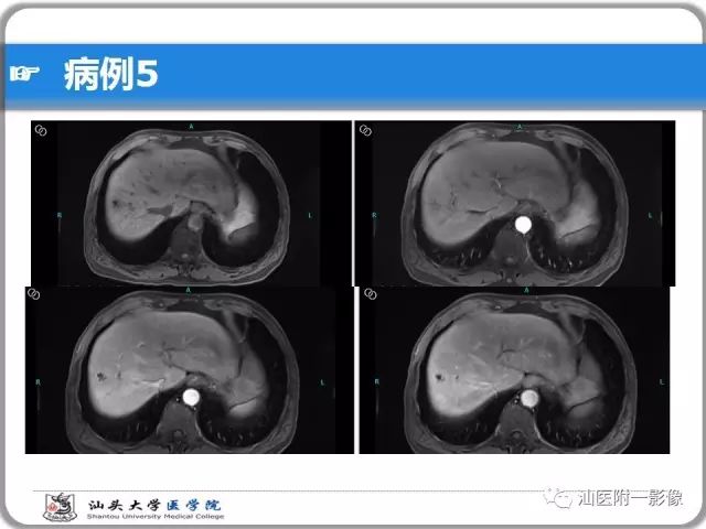 影像PPT - 【PPT】肝脏占位性病变再学习、分析与体会-38