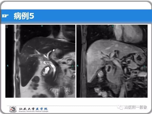 影像PPT - 【PPT】肝脏占位性病变再学习、分析与体会-39