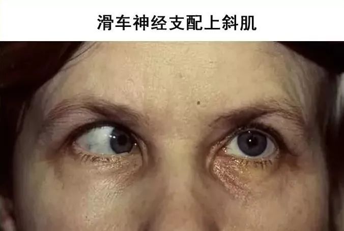 影像PPT - 眼肌及其支配的神经-19 影像PPT - 眼肌及其支配的神经-19
