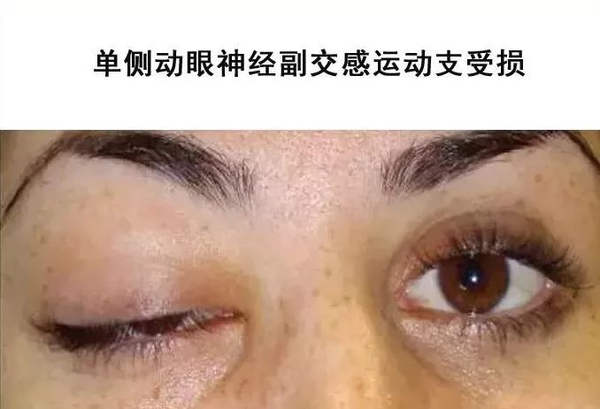 影像PPT - 眼肌及其支配的神经-24 影像PPT - 眼肌及其支配的神经-24