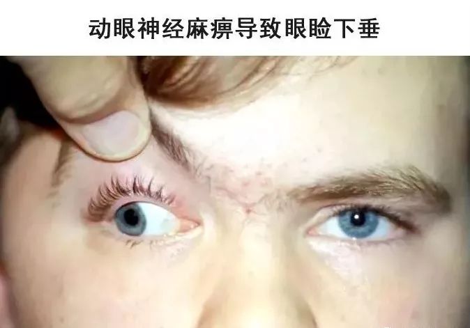 影像PPT - 眼肌及其支配的神经-23 影像PPT - 眼肌及其支配的神经-23
