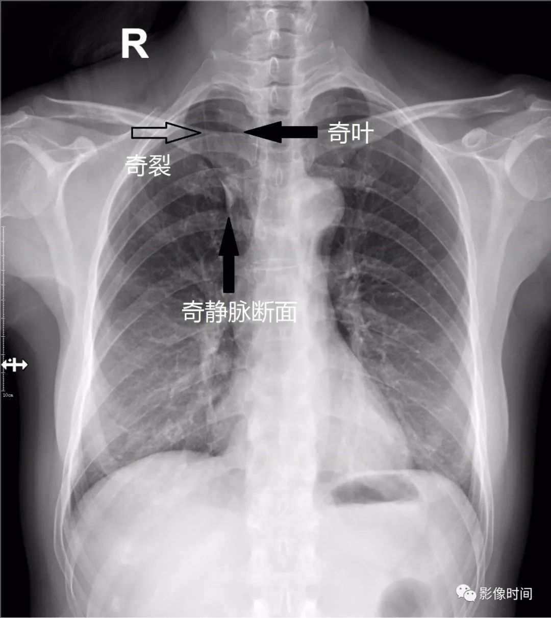影像PPT - 肺奇叶与奇静脉裂-2 影像PPT - 肺奇叶与奇静脉裂-2