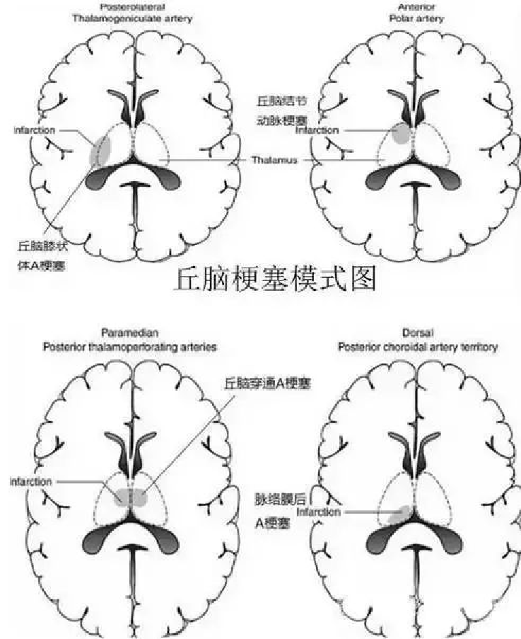 影像PPT - 【病例】双侧丘脑梗死—Percheron动脉梗死1例MR影像-3 影像PPT - 【病例】双侧丘脑梗死—Percheron动脉梗死1例MR影像-3