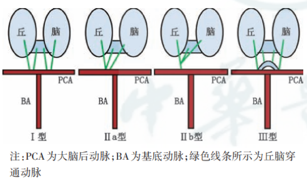 影像PPT - 【病例】双侧丘脑梗死—Percheron动脉梗死1例MR影像-4 影像PPT - 【病例】双侧丘脑梗死—Percheron动脉梗死1例MR影像-4