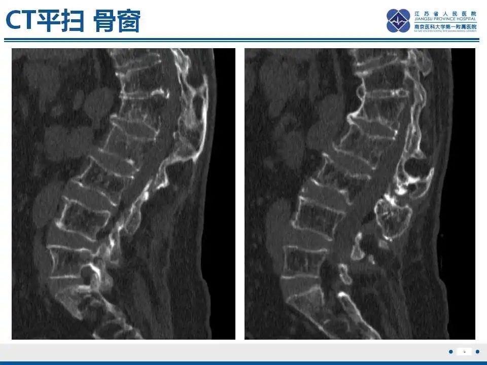 影像PPT - 【PPT】虚拟去钙技术在骨髓水肿中的应用-4