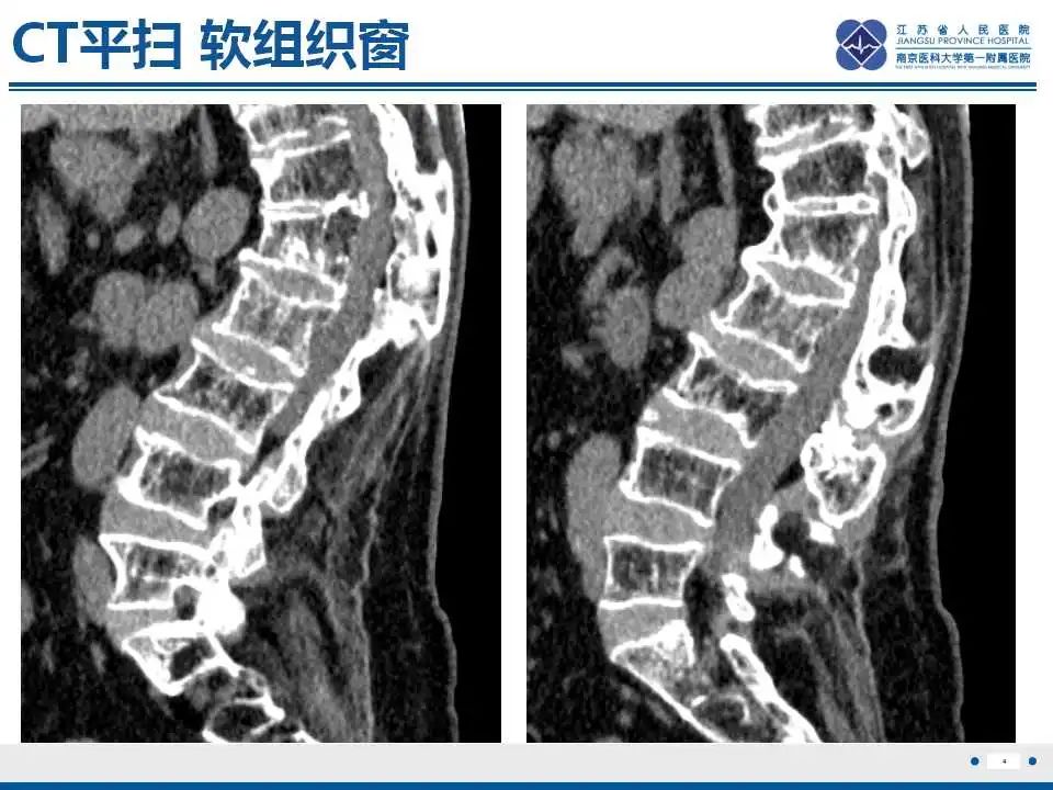 影像PPT - 【PPT】虚拟去钙技术在骨髓水肿中的应用-5
